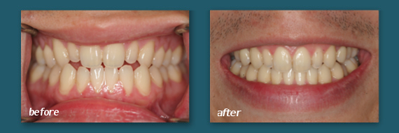 get clear braces to straighten teeth in San Diego