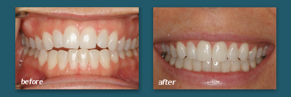 use Invisalign to straighten teeth in San Diego