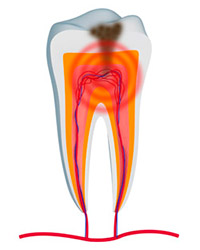 Diagram of an infected tooth in need of a root canal from Marcos Ortega in Hillcrest - downtown San Diego