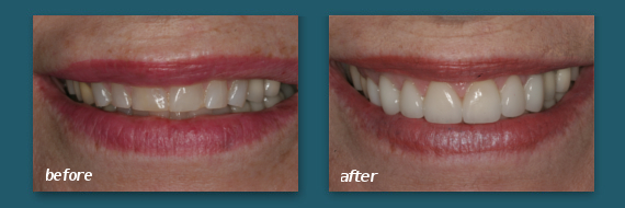 Hillcrest patient with dental veneers.