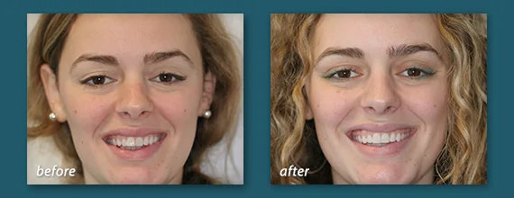 Invisalign Before and After - Marcos Ortega Hillcrest San Diego Dentist