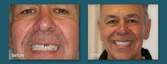 Implant Dentistry Before and After - Marcos Ortega Hillcrest San Diego Dentist