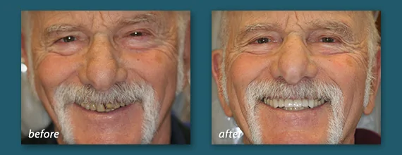 Dental Crowns Before and After - Marcos Ortega Hillcrest Downtown San Diego Dentist