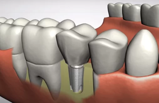 Dental Implant - Marcos Ortega Hillcrest San Diego Dentist