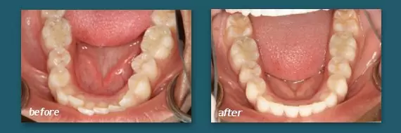 straighten teeth with clear braces from a San Diego dentist