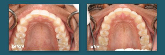 use Invisalign to straighten teeth from a San Diego dentist