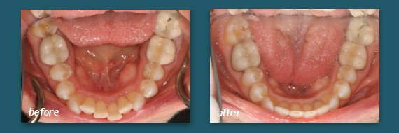 San Diego dentist can straighten teeth with clear braces