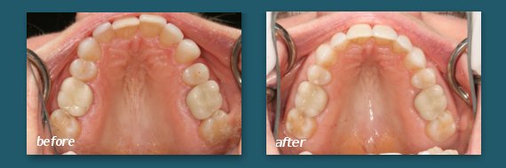 dentist in San Diego can straighten teeth with Invisalign